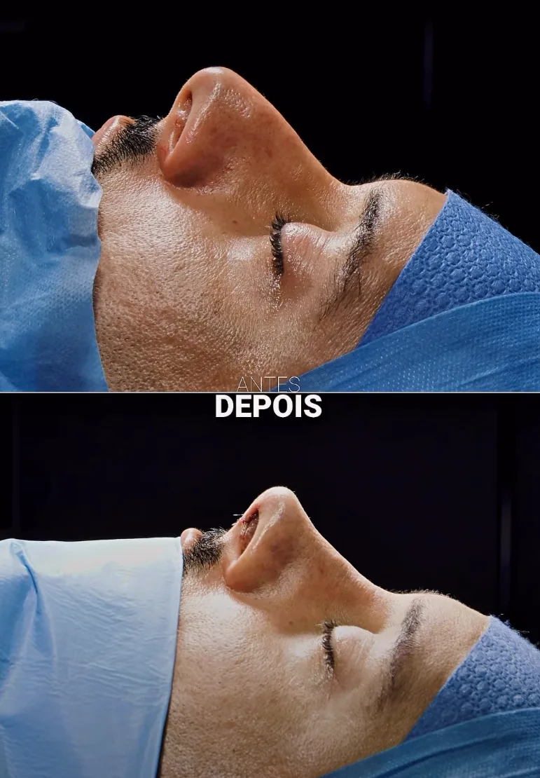 Antes e depois de rinoplastia, visão base do nariz