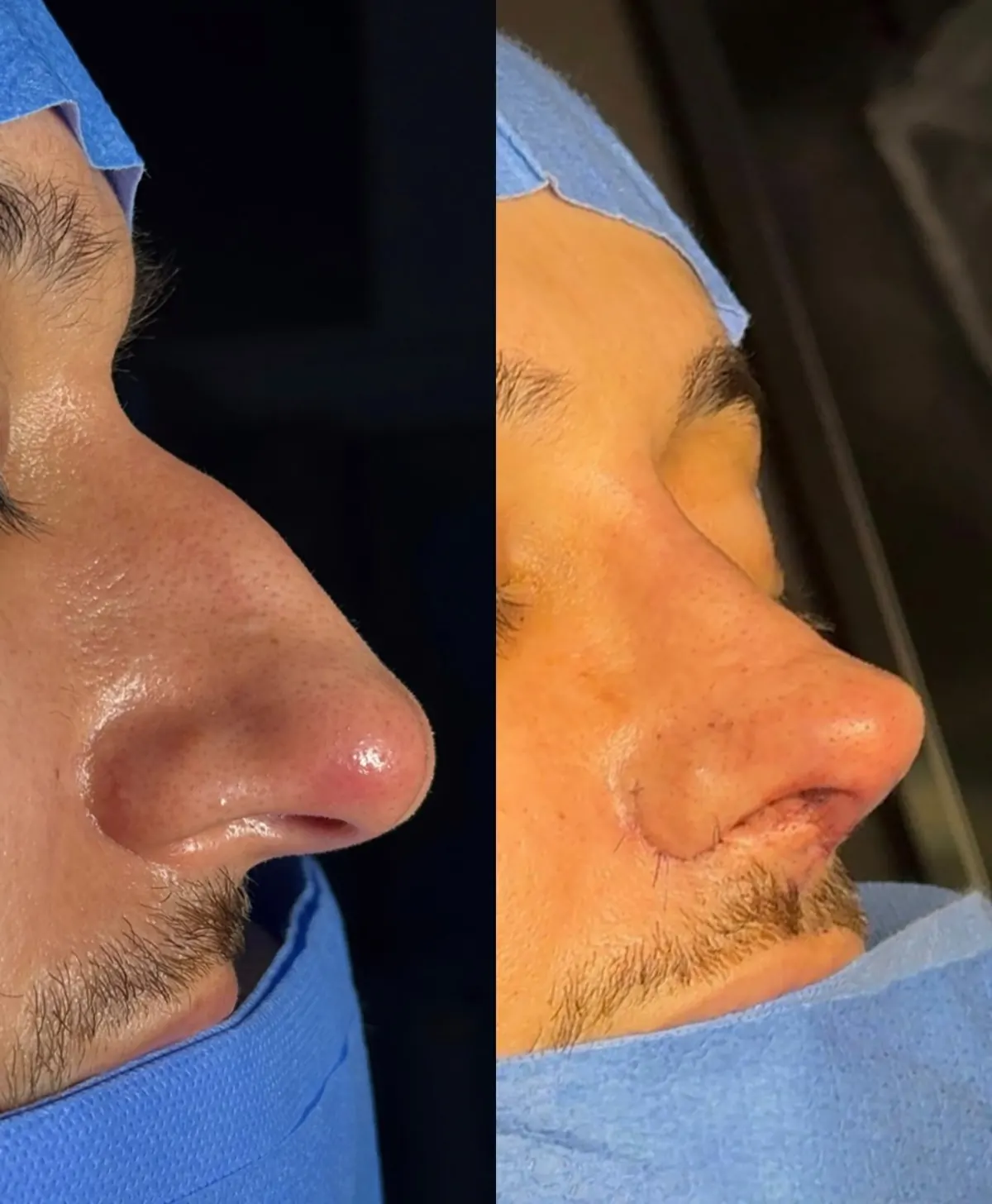 Comparativo de perfil antes e depois da rinoplastia